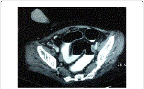 Contrast Enhanced Computed Tomography Cect Image Showing A Soft