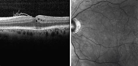 Macular Edema Oct