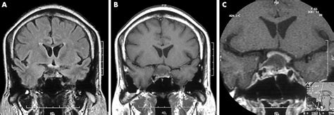 Pituitary Tumor Optic Chiasm