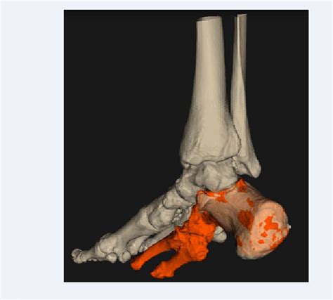 [pdf] Surgical Correction Of A Deformed Mid Hindfoot Using Preoperative 3 D Planning Of An