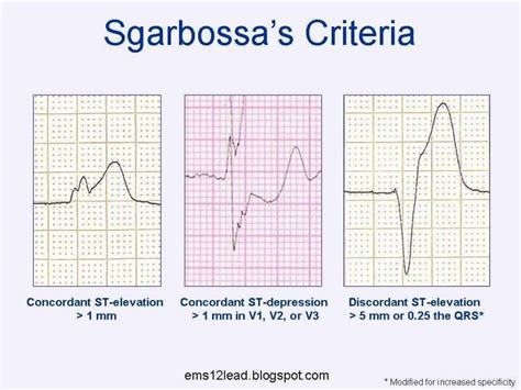 Ecg Lbbb And Acute Mi