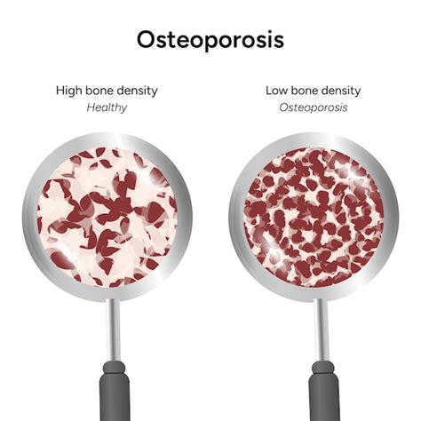 Infográfico de zoom de baixa e alta densidade óssea de osteoporose em