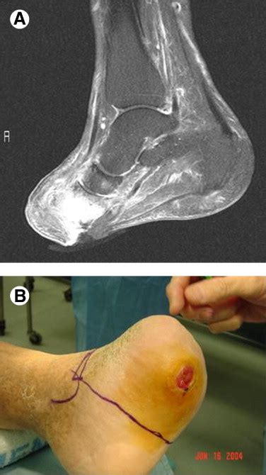 Syme Amputation For Limb Salvage Early Experience With 26 Cases The