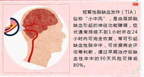 健康点 警惕短暂性脑缺血发作（tia）评估