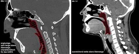 Wissenswertes Zum Upper Airway Resistance Syndrom Obstruktive