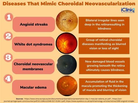 Choroidal Neovascular Membrane Diagram