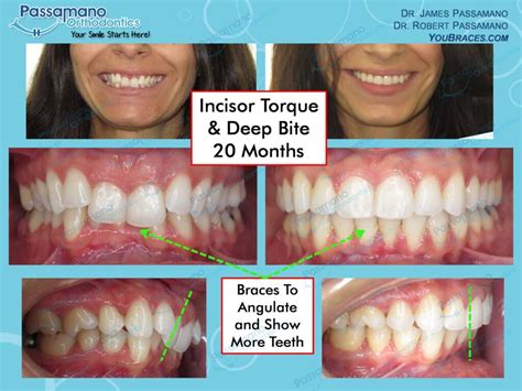 Deep Bite and Incisors Torqued with Metal Braces - Passamano Orthodontics