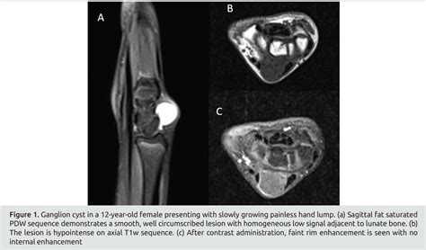 Radiological Appearences Of Benign Soft Tissue Tumors Of The Hand And Wrist With Special