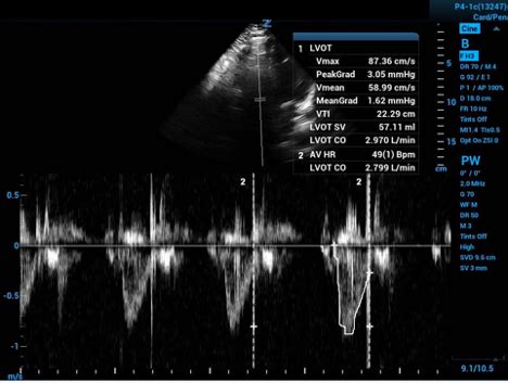 Advanced Critical Care Ultrasound Velocity Time Integral Before And