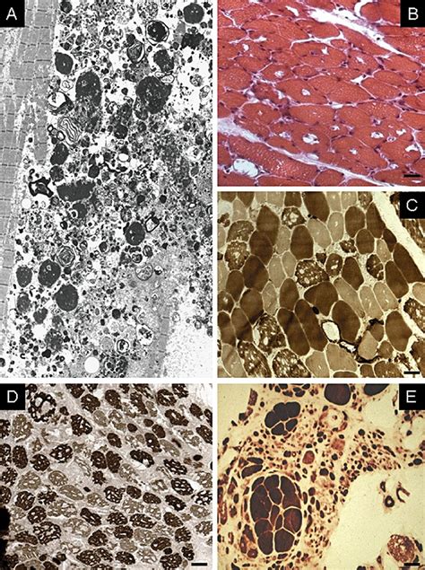 Autophagic Vacuoles In Type 2 Fibres And Neurogenic Atrophy In Glycogen