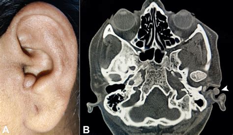 A Gross View Of The Lesion Over The Left Ears Cavum Concha B Head