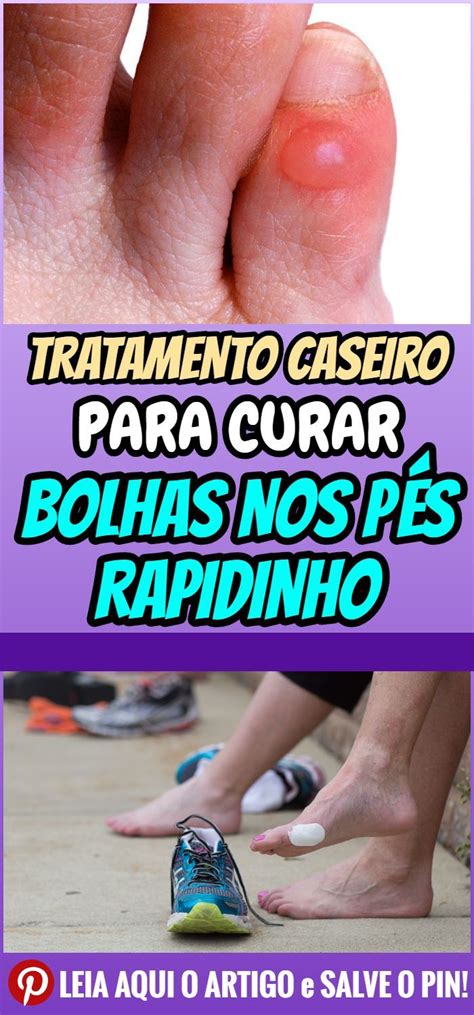 Receita Para Eliminar os Calos dos Pés em Casa em 15 Minutos bolhas