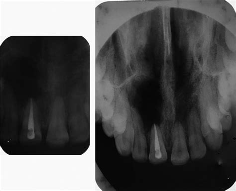 Maxillary Periapical Radiograph