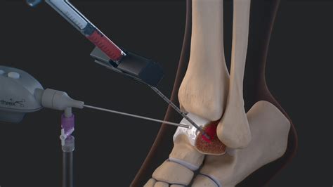 Arthrex Intraosseous Bioplasty Iobp Technique For Treatment Of