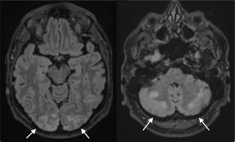 Magnetic Resonance Imaging Brain Multiple T2flair Hyperintensities