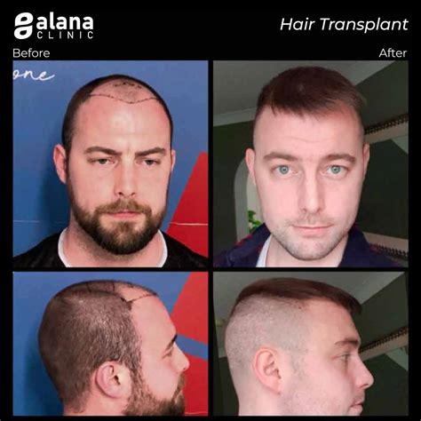 FUE Hair Transplant Turkey - Alana Hair Clinic