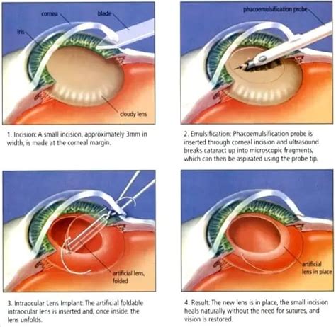 Cataracts Surgery Murdoch Eye Centre