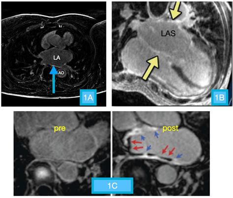 Cardiac Mri Images A Focal Area Of Hyperintense Signal Along The