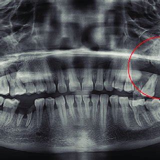 Orthopantomogram Showing Floating Appearance Of Left Maxillary Molars