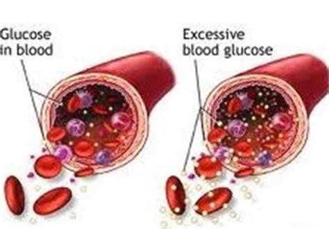 Dementia Risk Ties to Blood Sugar Level, Even with No Diabetes ...