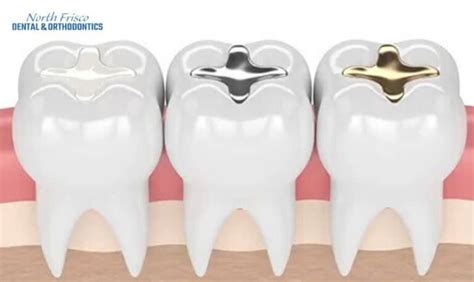 When To Get A Tooth Filling: The Importance Of Early Intervention