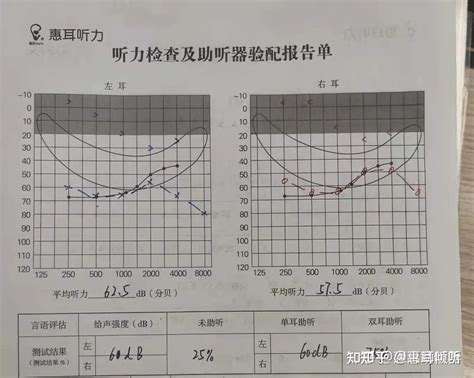 感音神经性耳聋佩戴助听器——渝北双龙惠耳助听器分享案例 知乎