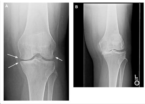 Anteroposterior Ap Projection Without Weight Bearing A The Download Scientific Diagram