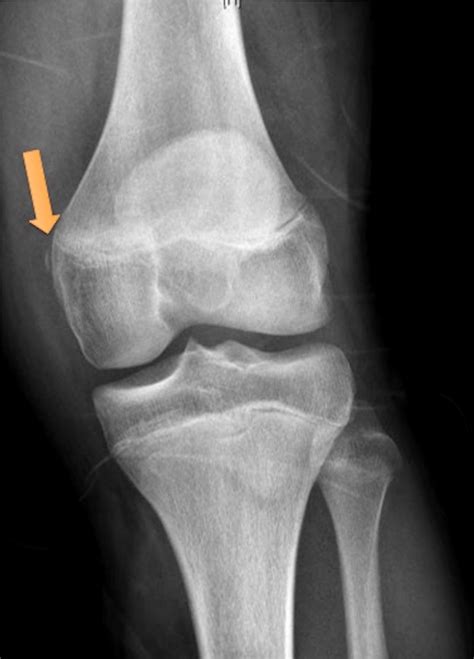 Lateral Knee Radiograph