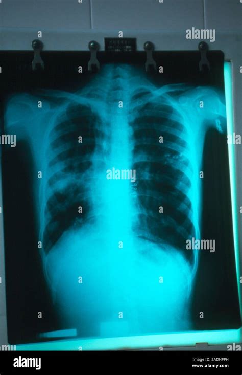 Tuberculosis Pulmonar La Radiografía De Tórax De Un Paciente Con