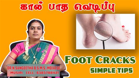 கல பத வடபப Foot crack simple home remedies in tamil YouTube