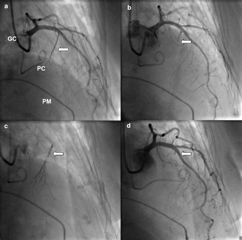 Angiographic Demonstration Of The Technique Of Alcohol Septal Ablation