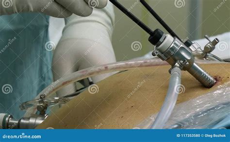 Abdominal Laparoscopy in Operating Room Close-up. Stock Footage - Video ...