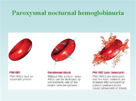 Sugar Water Screening Test Paroxysmal Nocturnal Hemoglobinuria PNH