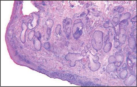 Figure 4 From Excision Of Periocular Basal Cell Carcinoma With Stereoscopic Microdissection Of