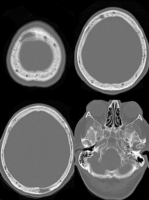 Spectrum Of Lytic Lesions Of The Skull A Pictorial Essay Springerlink