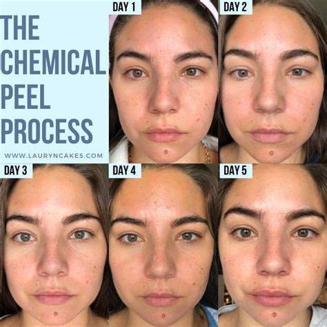 “chemical Peel Recovery Time What To Expect And How Long It Takes To