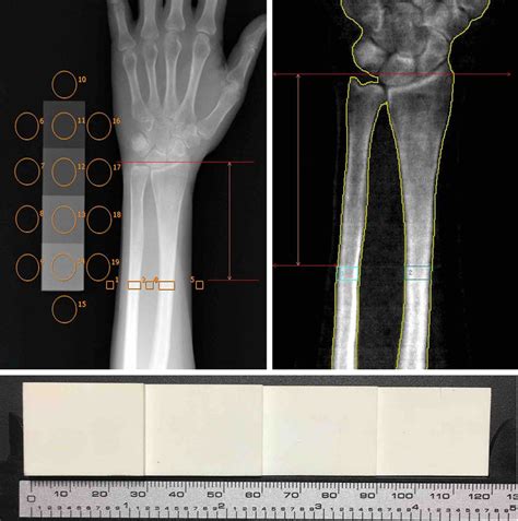 Xbone And DXA Images Of The Distal Forearm And An Image Of The 4 Step