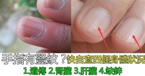 指甲上出現「豎紋」，多數預示著4個問題，可能需要你多加留心！