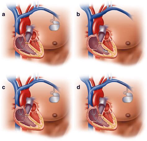 Innovations in pacemakers. A Dual chamber pacemaker with ventricular... | Download Scientific ...