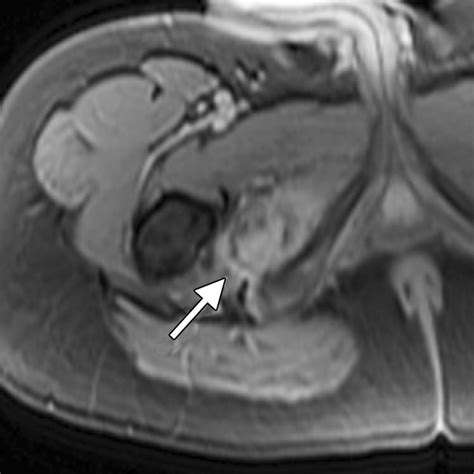 Soft Tissue Tumors And Tumorlike Lesions A Systematic Imaging Approach Radiology