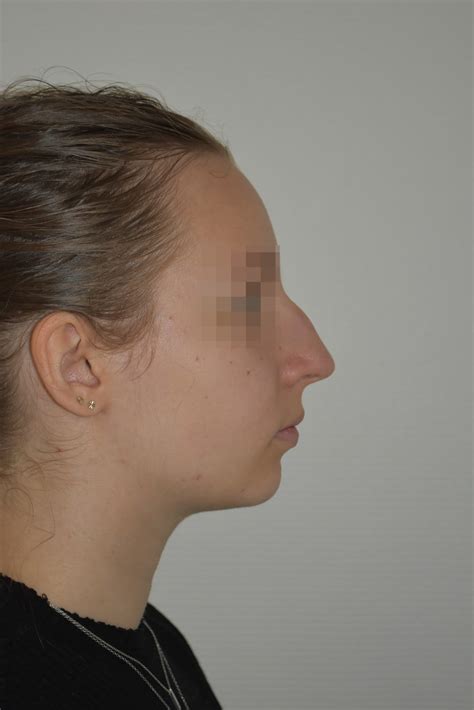 Avant Apr S Rhinoplastie G Nioplastie Du Docteur Martin