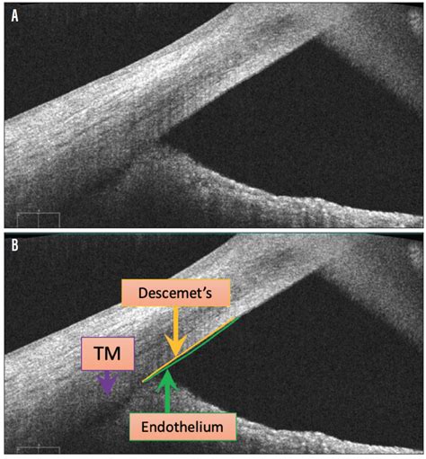 Anterior Segment OCT: Precision Angle Imaging - Glaucoma Today