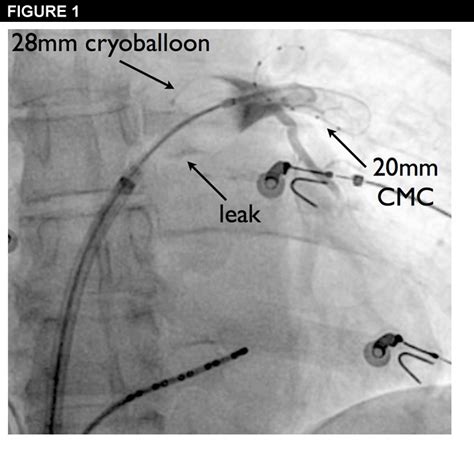 Assessing The Efficacy Of Cryoballoon Ablation American College Of Cardiology