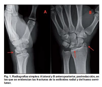 Fractura Luxaci N Transemilunar