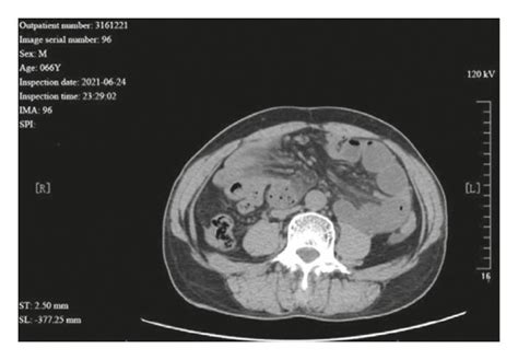 A 66 year-old male patient with paraduodenal hernia. The CT image shows ...