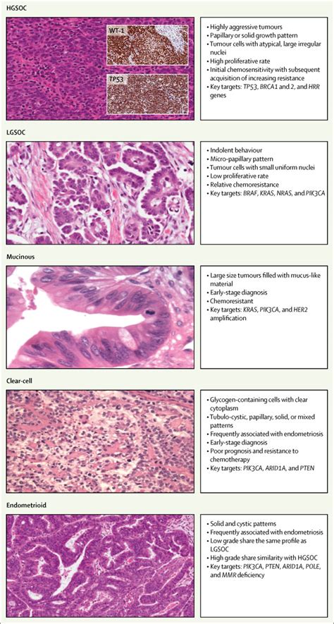 Epithelial Ovarian Cancer The Lancet