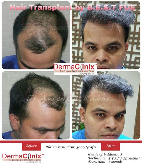 Best Hair Transplant