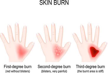 Burns degree first aid for burn wound fire Vector Image