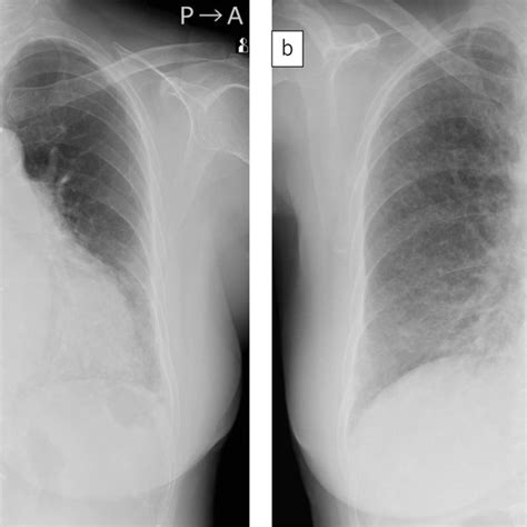 A Chest Radiograph Taken 13 Years After Coronary Artery Bypass