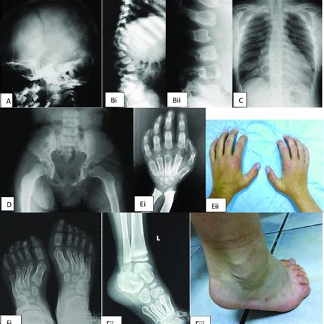 Radiological Abnormalities Seen In Our Patients With Mps Type Ii A